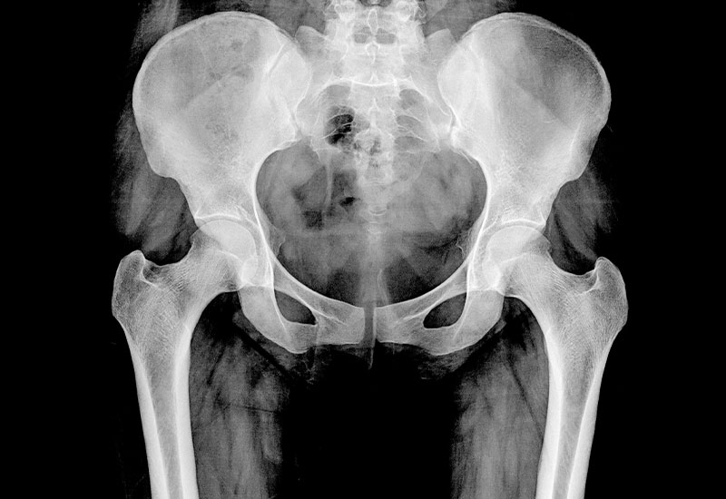 hip-xray image